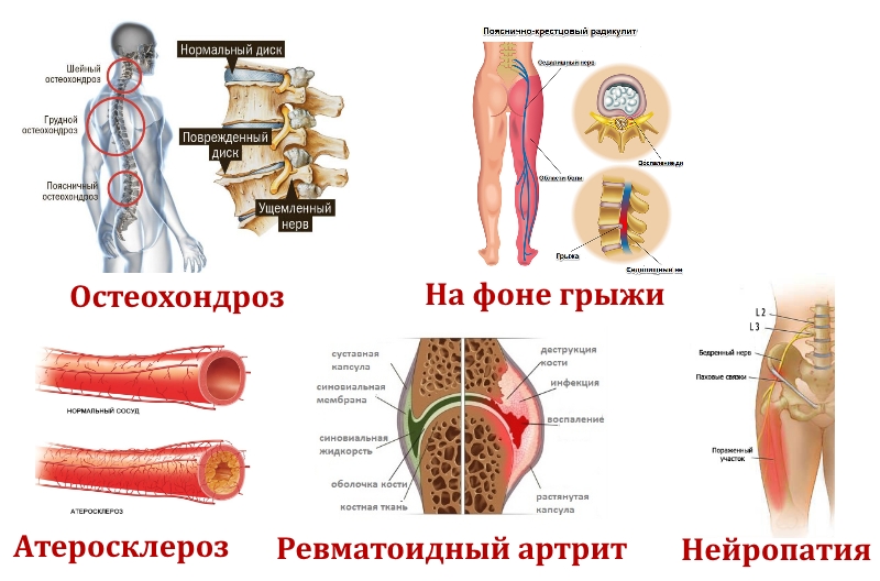 Причины онемения бедра Причины онемения бедра