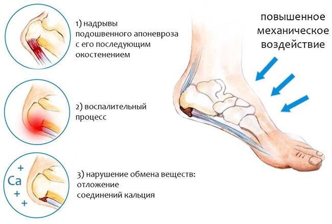 Причины плантарного фасциита Причины плантарного фасциита
