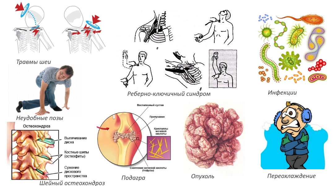 Причины плексита плеча Причины плексита плеча