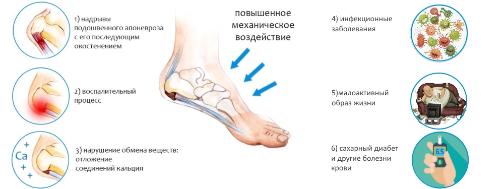Причины пяточной шпоры Причины пяточной шпоры