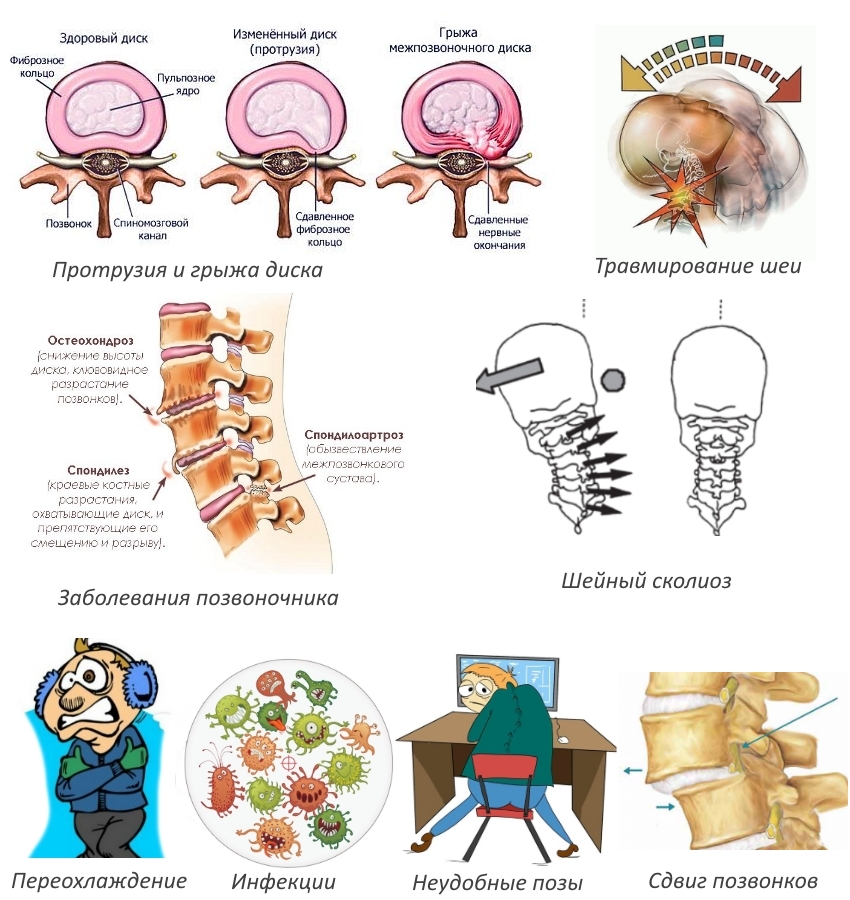 Причины шейного спондилоартроза Причины шейного спондилоартроза