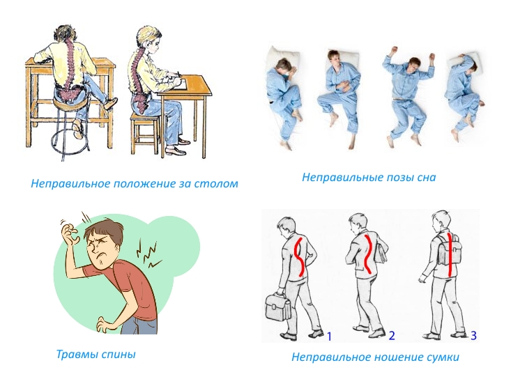 Частые причины сколиоза Частые причины сколиоза