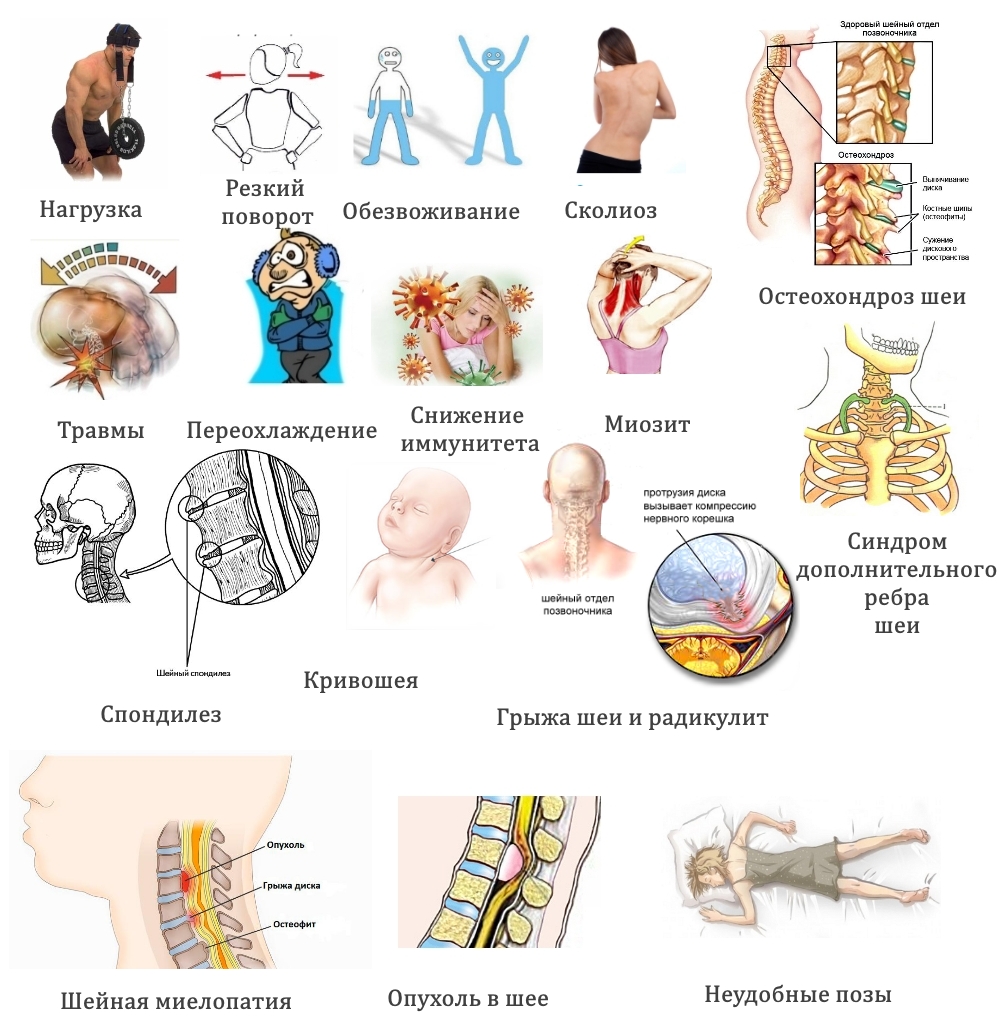 Частые причины боли в шее Частые причины боли в шее