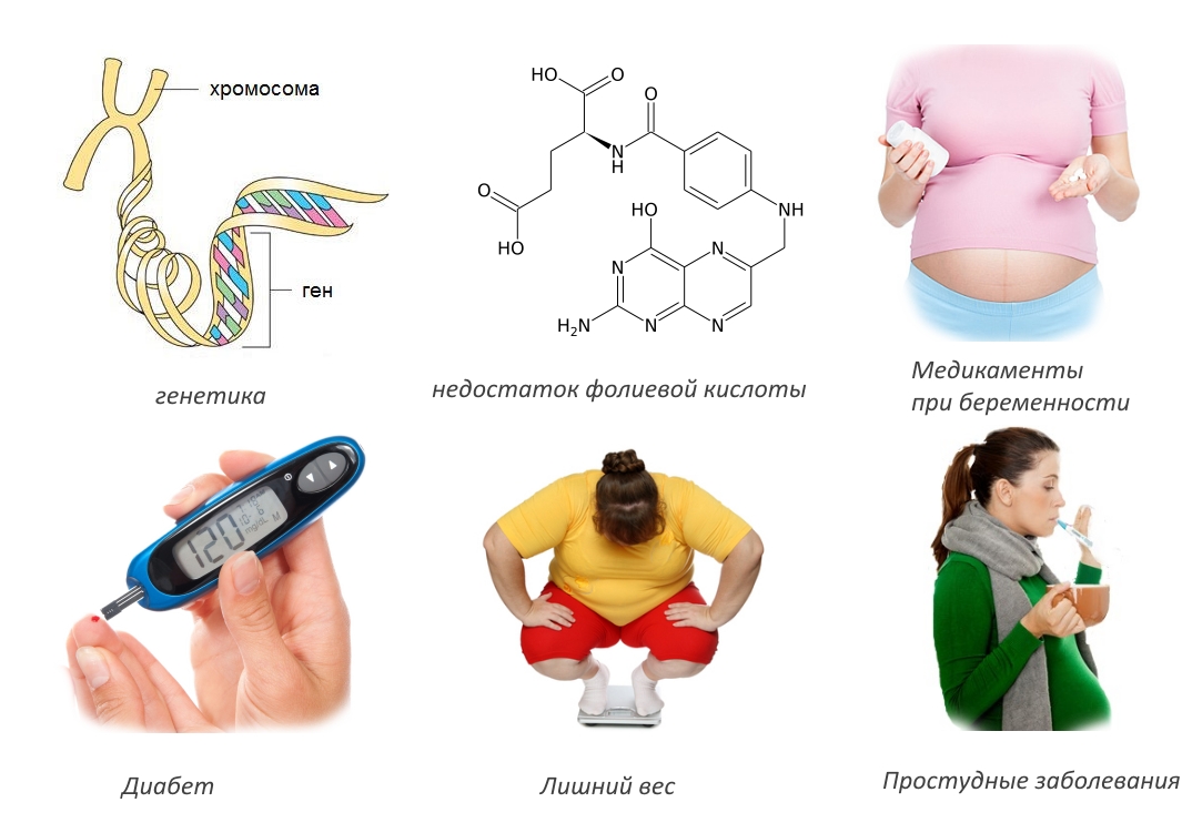 Причины спины Бифида Причины спины Бифида
