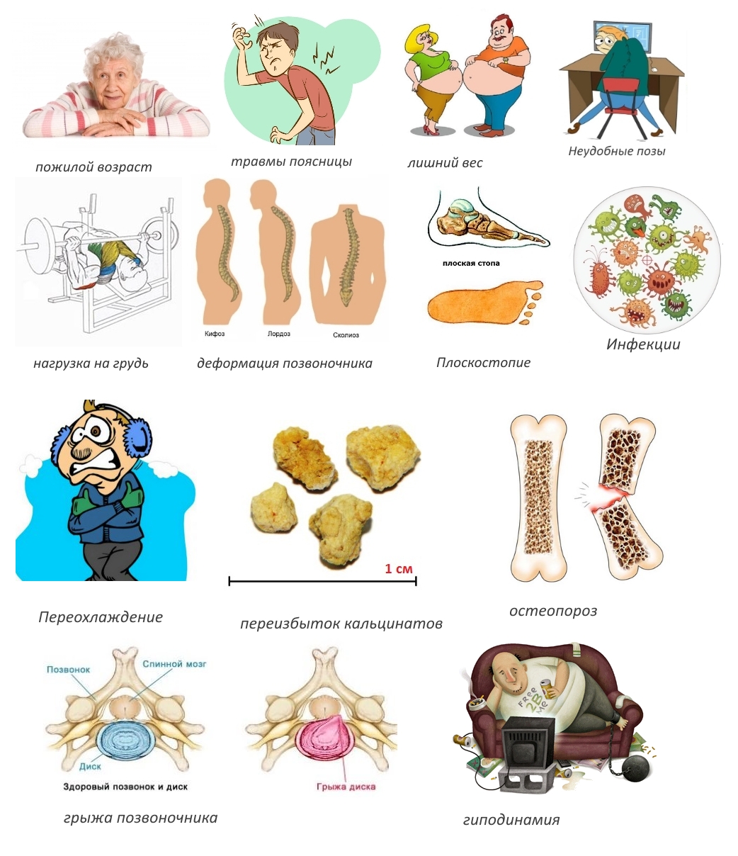 Причины спондилеза поясничного отдела Причины спондилеза поясничного отдела