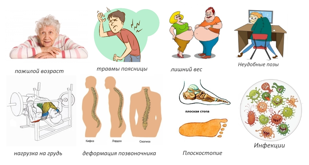 Причины спондилоартроза поясничного отдела Причины спондилоартроза поясничного отдела