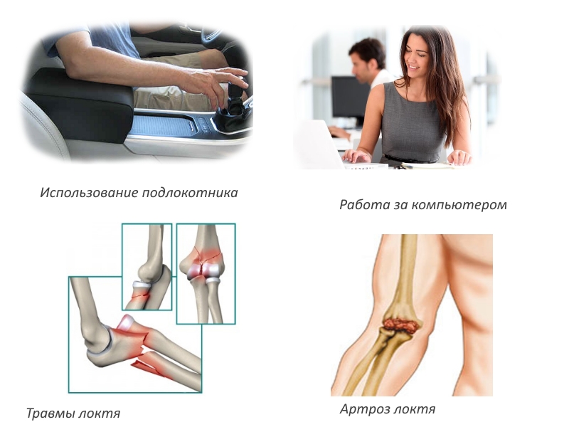 Причины туннельного локтевого синдрома Причины туннельного локтевого синдрома