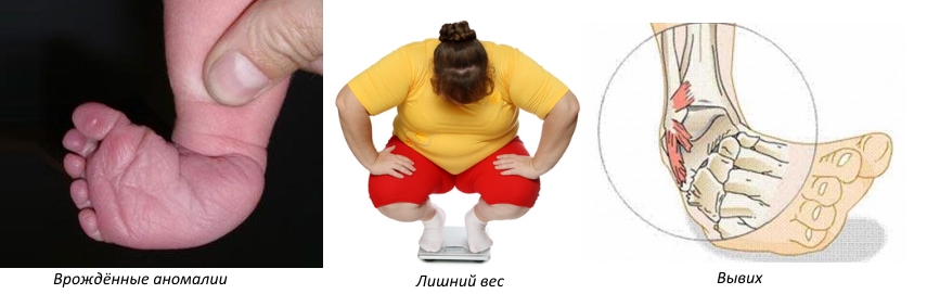 Частые причины вальгусной деформации Частые причины вальгусной деформации