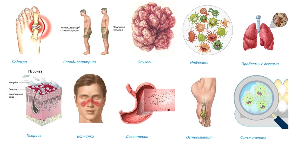 Причины воспаления голеностопного сустава Причины воспаления голеностопного сустава