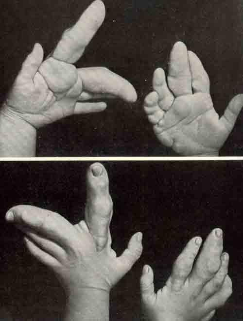 Пример деформации при хондродисплазие Пример деформации при хондродисплазие