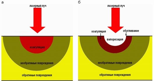 Принцип действия лазерного лечения Принцип действия лазерного лечения