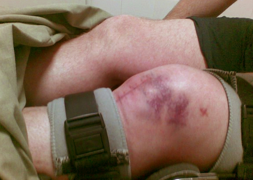 Припухлость и гематома