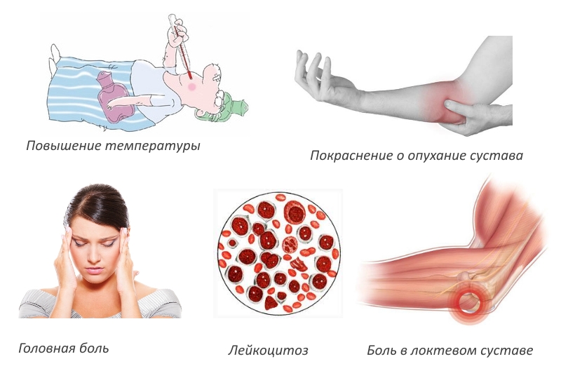 Признаки локтевого артрита Признаки локтевого артрита