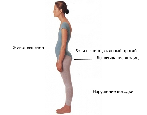 Признаки лордоза Признаки лордоза