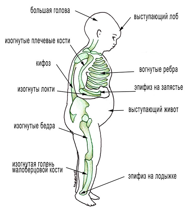 Признаки рахита Признаки рахита