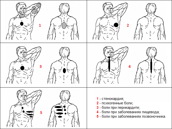 Признаки синдрома торакалгии Признаки синдрома торакалгии