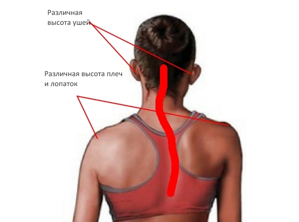 Признаки сколиоза шеи Признаки сколиоза шеи