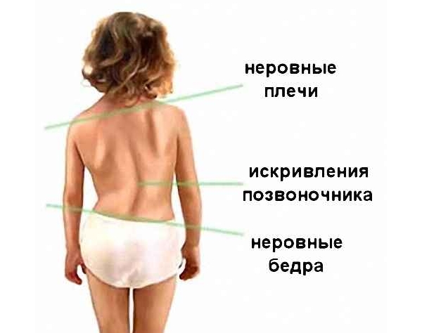 Визуальные признаки сколиоза Визуальные признаки сколиоза