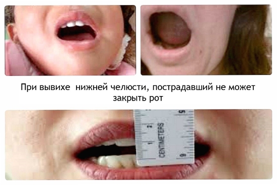 Смещение при вывихе челюсти Смещение при вывихе челюсти