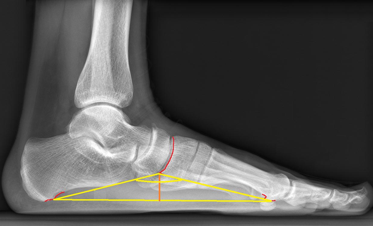 Продольное плоскостопие на рентген снимке Продольное плоскостопие на рентген снимке