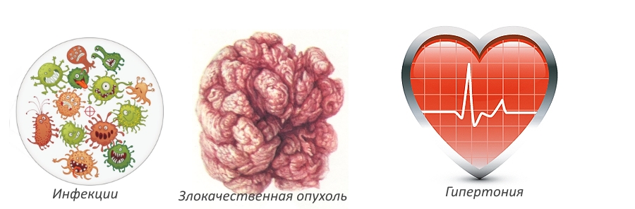 Противопоказания для массажа при грыже поясницы Противопоказания для массажа при грыже поясницы