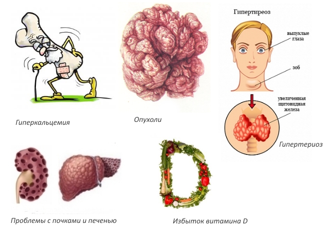 Противопоказания для приема Кальцемина Противопоказания для приема Кальцемина