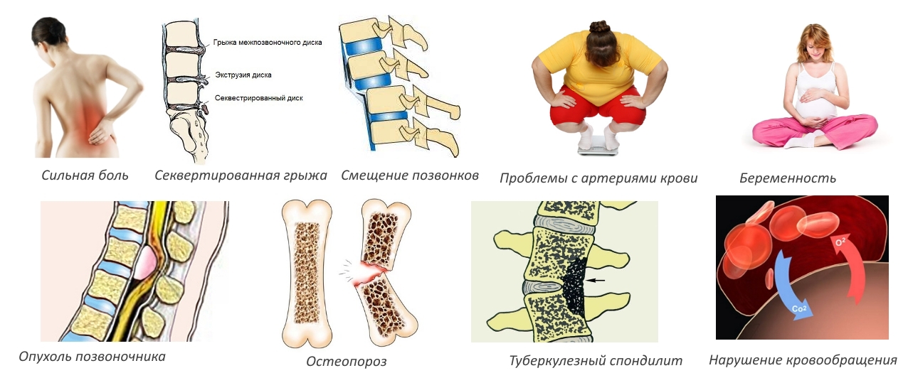 Противопоказания для вытягивания позвоночника Противопоказания для вытягивания позвоночника