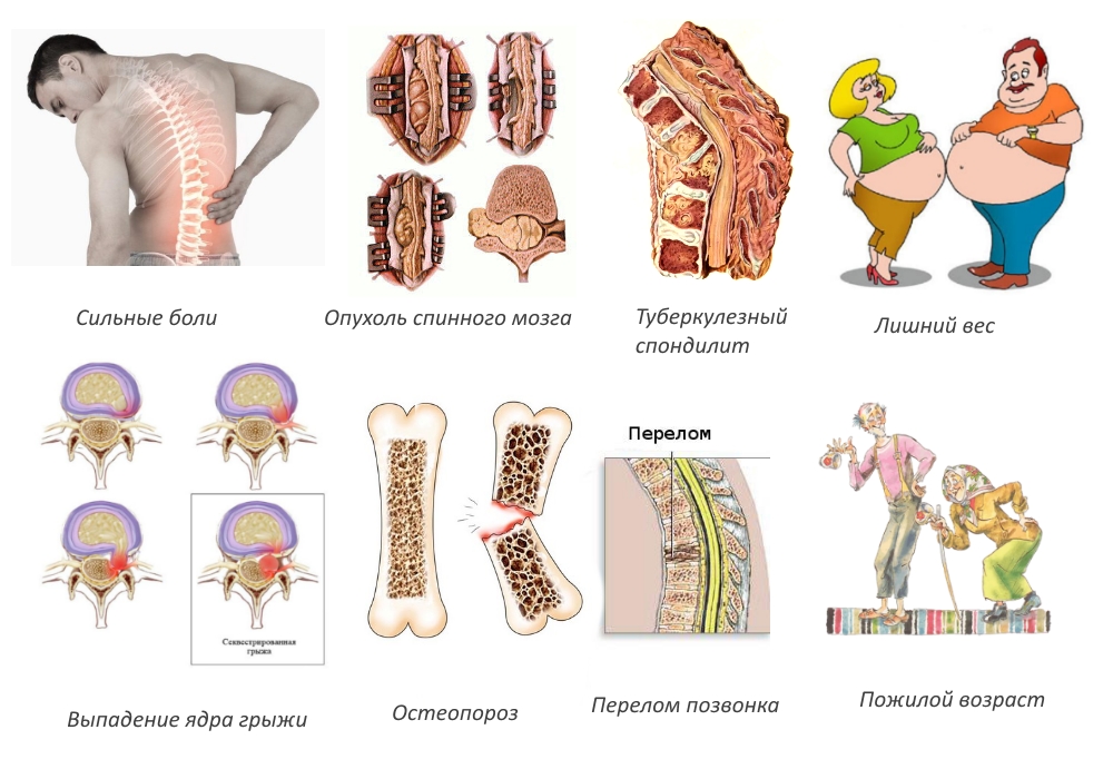 Противопоказания к вытяжению позвоночника йогой Противопоказания к вытяжению позвоночника йогой