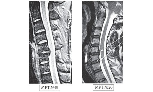 Протрузия диска с5-с6 на МРТ Протрузия диска с5-с6 на МРТ