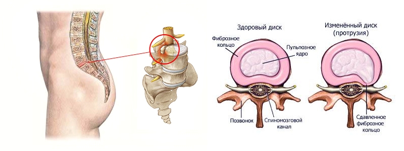 Протрузия поясничного отдела позвоночника Протрузия поясничного отдела позвоночника