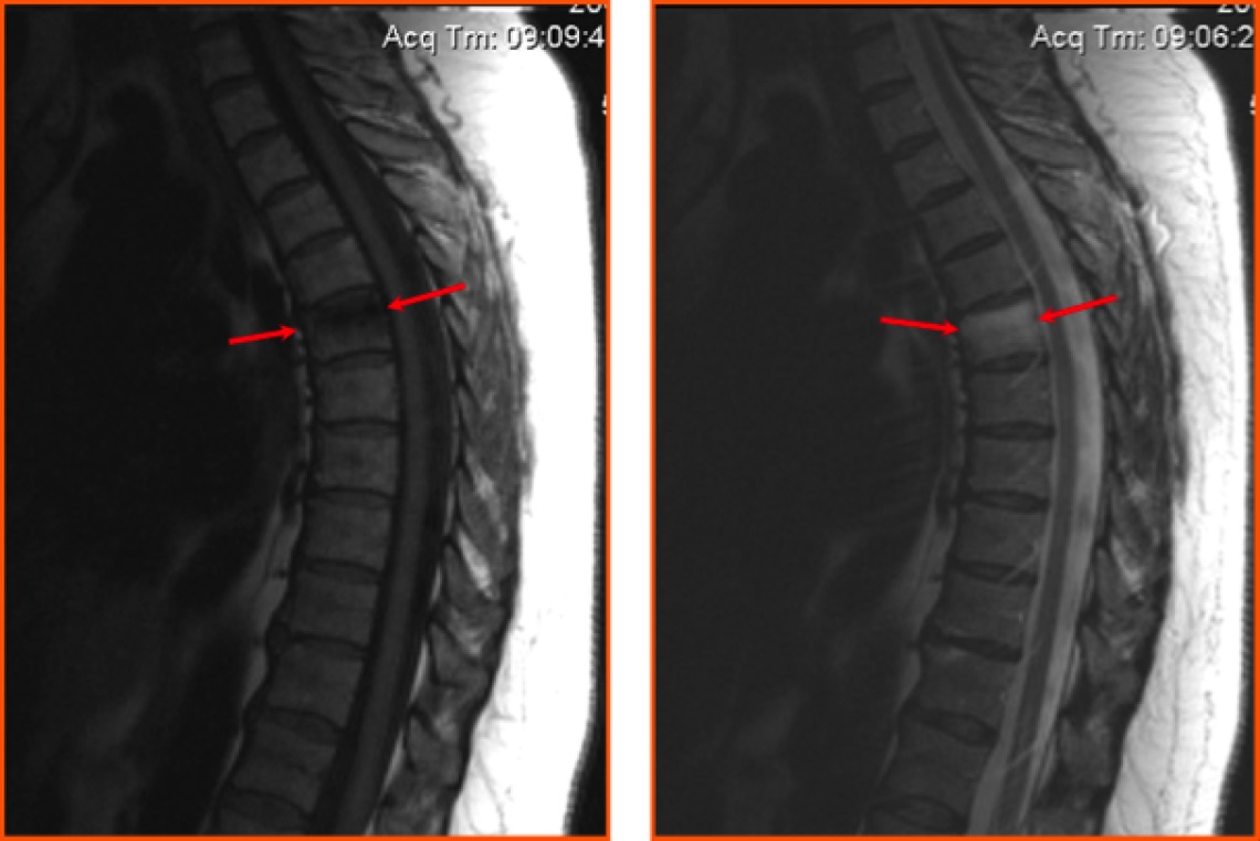 Протрузия грудного отдела на МРТ Протрузия грудного отдела на МРТ