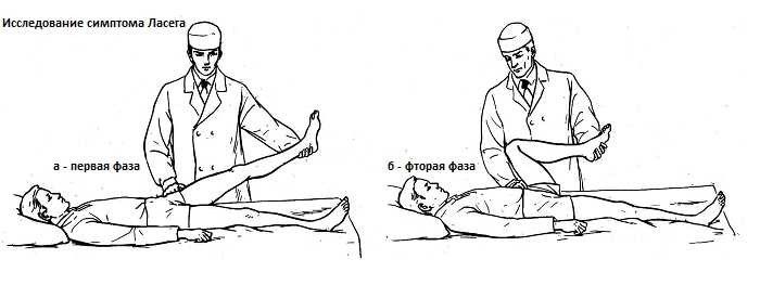 Исследование на симптом Ласега Исследование на симптом Ласега