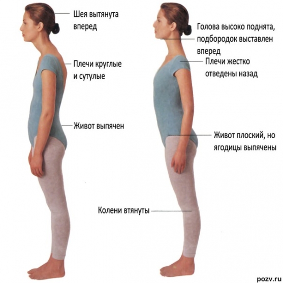 Проявление лордоза Проявление лордоза