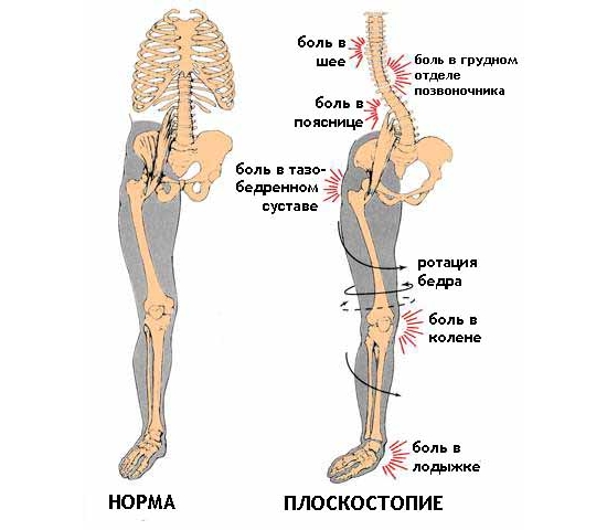 Проявление плоскостопия Проявление плоскостопия