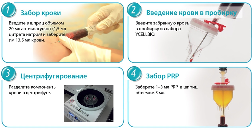 Этапы prp–терапии Этапы prp–терапии