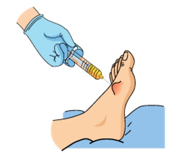 Проведение пункции Проведение пункции