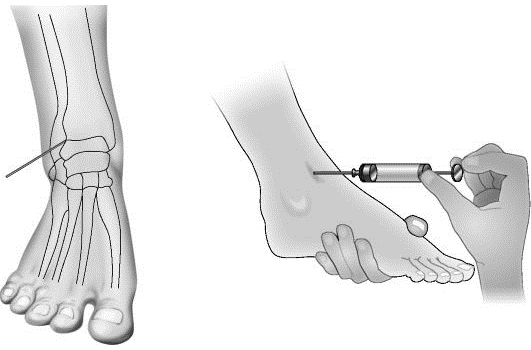 Пункция голеностопного сустава Пункция голеностопного сустава