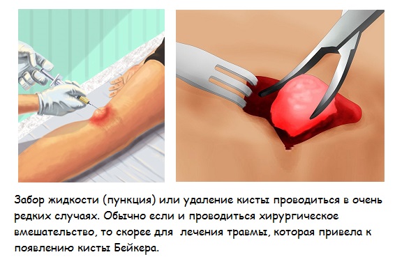 Пункция и удаление кисты Пункция и удаление кисты