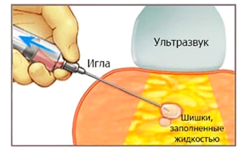 Пункция кисты пятки Пункция кисты пятки