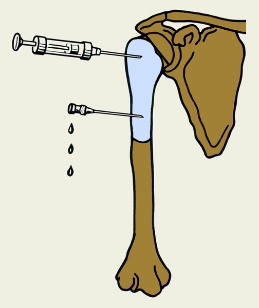 Пункция костной кисты Пункция костной кисты