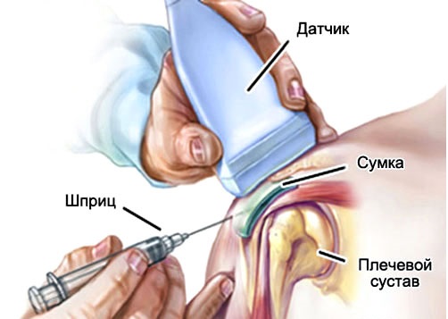 Пункция плеча под контролем УЗИ Пункция плеча под контролем УЗИ