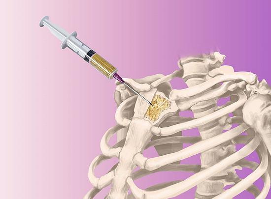 Пункция при остеомиелите Пункция при остеомиелите