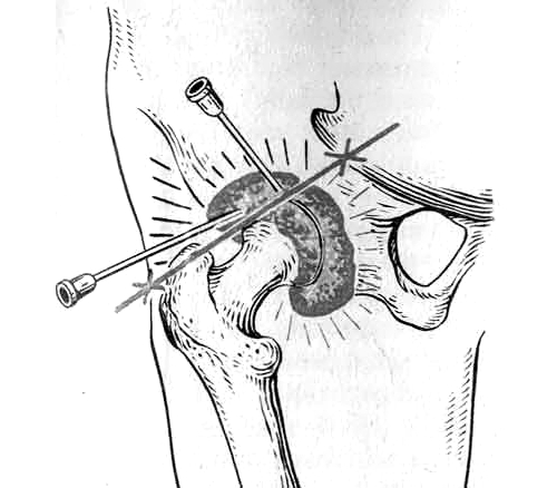Пункция тазобедренного сустава