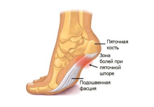 Пяточная шпора Пяточная шпора