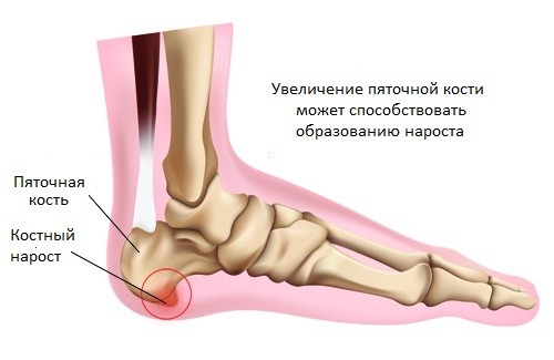 Пяточная шпора Пяточная шпора