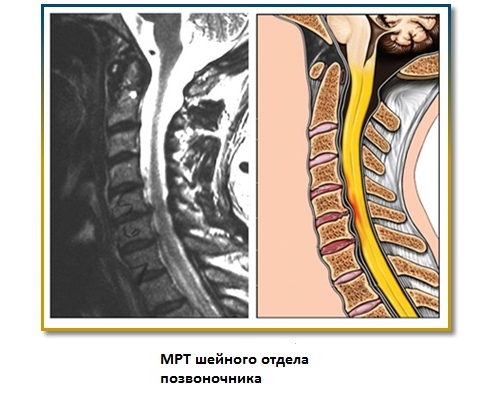 Радикулит на МРТ Радикулит на МРТ