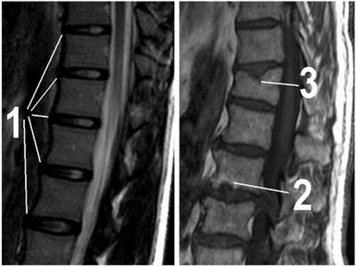 Радикулит на МРТ снимке Радикулит на МРТ снимке