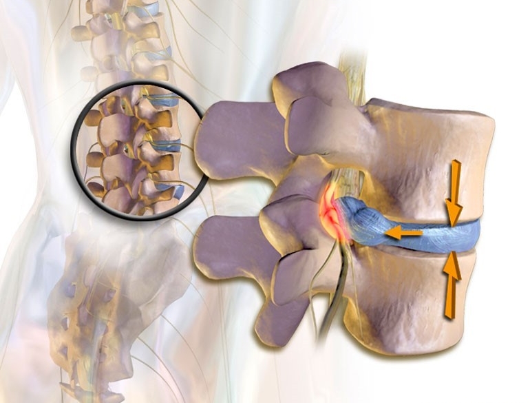 Корешковый синдром Корешковый синдром