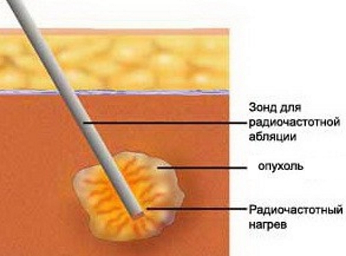 Радиочастотная абляция остеомы Радиочастотная абляция остеомы