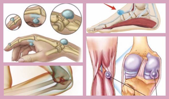 Распространение гигром около суставов Распространение гигром около суставов